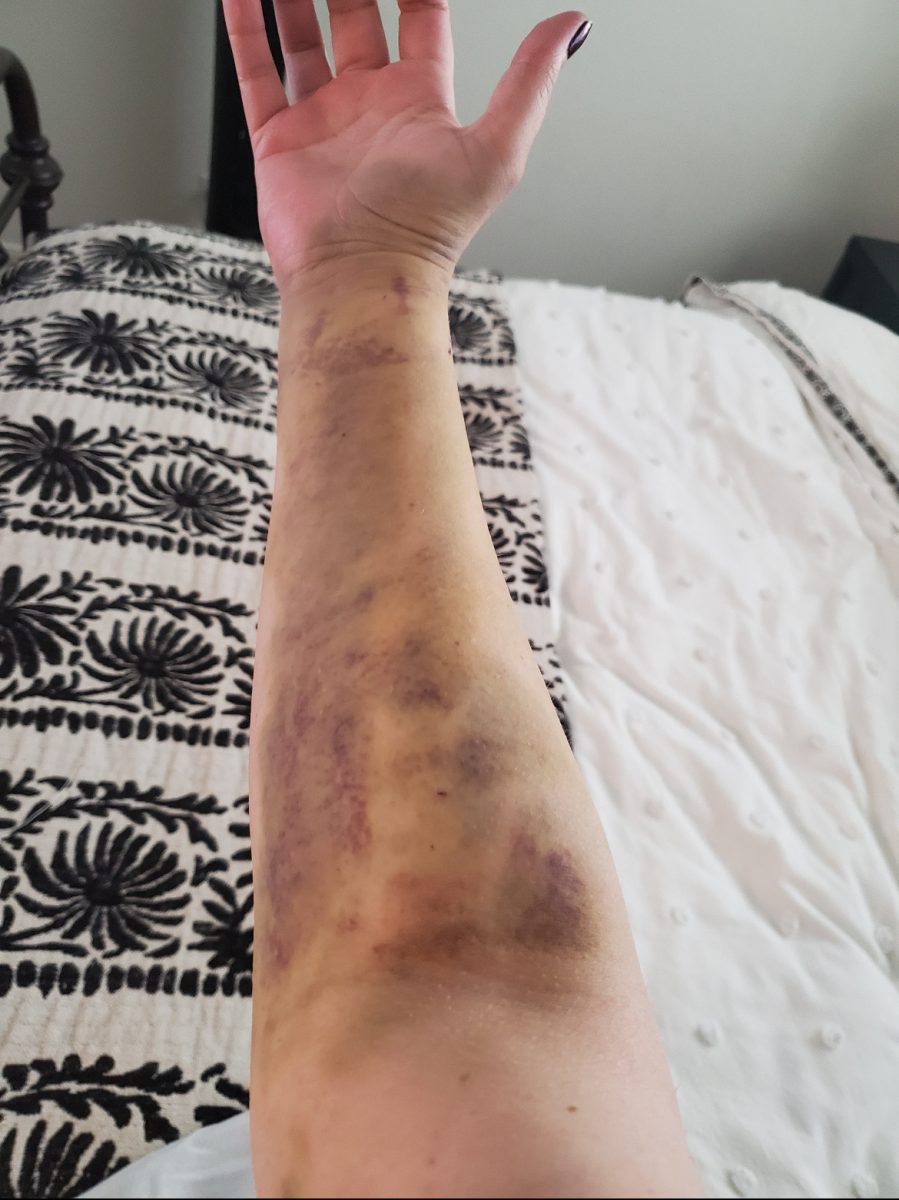 Recovery from surgery.